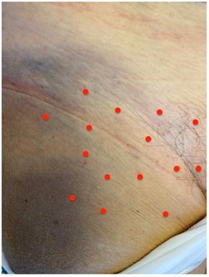 Botulinum toxin type A for genitofemoral neuralgia: A case report